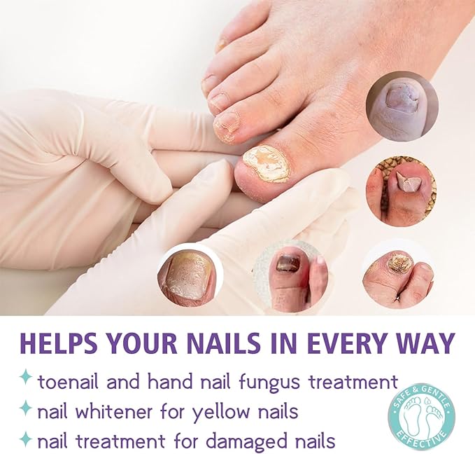 Gentle Nail Fungus Remover Maxum